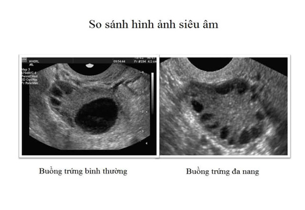Chẩn đoán PCOS