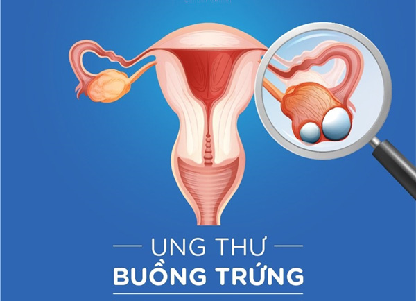 Ung thư buồng trứng “kẻ giết người thầm lặng”
