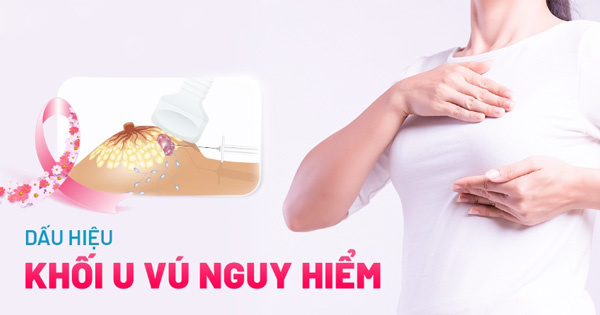 dấu hiệu khối u vú nguy hiểm