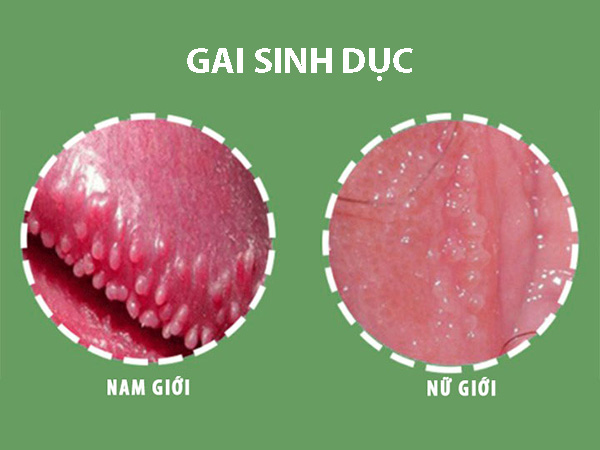 Gai sinh dục nữ là gì? Có nguy hiểm không?