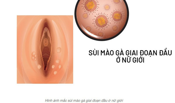 giai đoạn đầu sùi mào gà