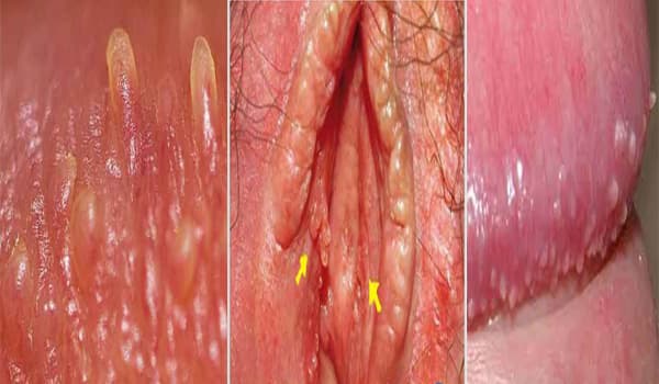 hình ảnh gai sinh dục