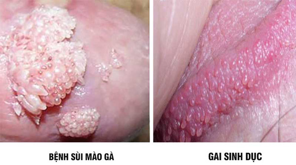 sùi mào gà và gai sinh dục