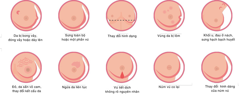 triệu chứng thường thấy bệnh lý tuyến vú