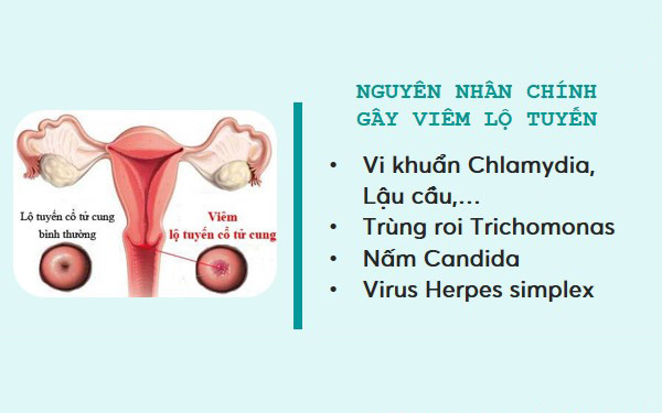 Nguyên nhân gây viêm lộ tuyến cổ tử cung