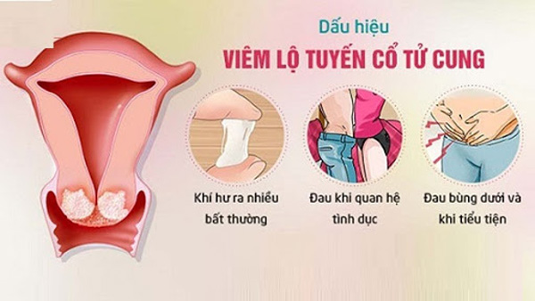 Triệu chứng của viêm lộ tuyến cổ tử cung