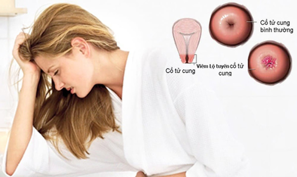 Viêm lộ tuyến cổ tử cung là gì?