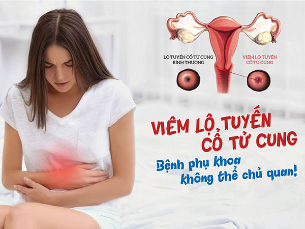 Viêm lộ tuyến cổ tử cung là gì?