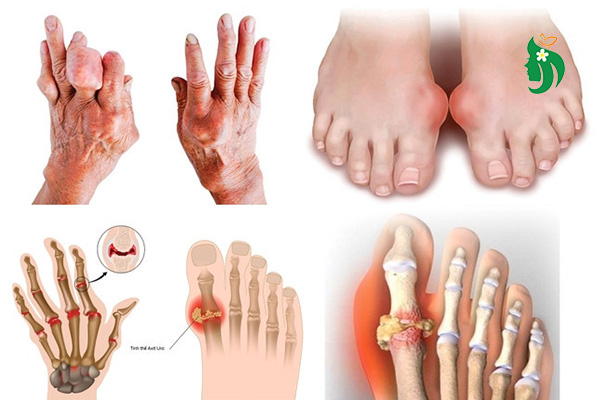 Bị gút kiêng ăn gì? Chuyên gia dinh dưỡng khuyến cáo bạn cần biết