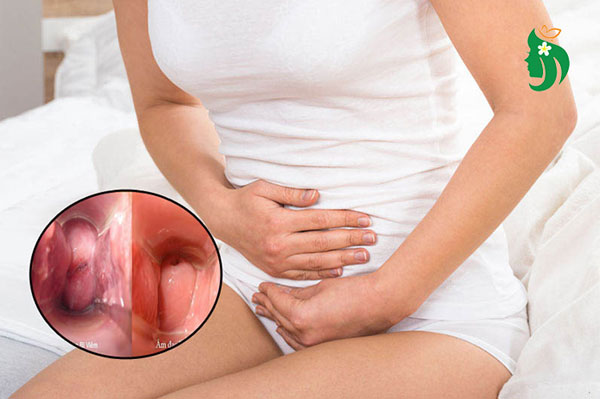 Viêm âm đạo là gì? Vì sao nhiều người mắc?