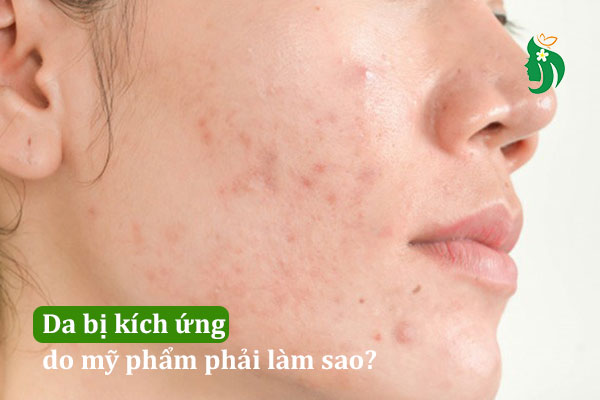 Da bị kích ứng do mỹ phẩm phải làm sao?