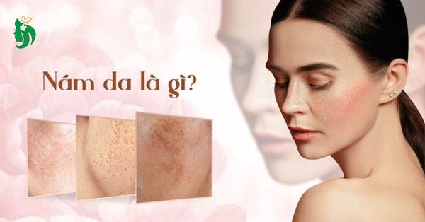 Nám da là gì? Tại sao cần điều trị đúng cách?
