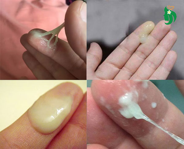 Nguyên nhân khiến huyết trắng ra nhiều