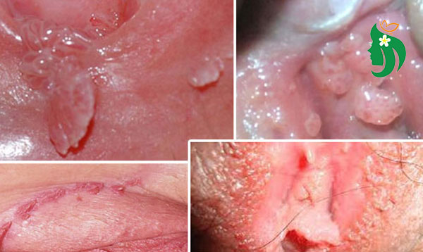 ngứa vùng kín nữ