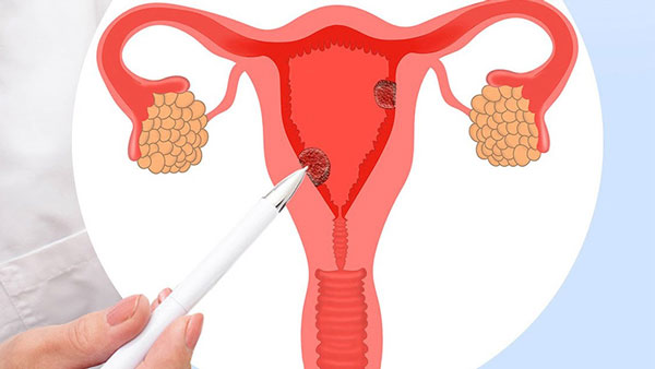 Phụ nữ buồng trứng đa nang cần lưu ý gì?