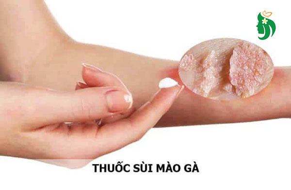 Cách điều trị sùi mào gà ở nữ giới
