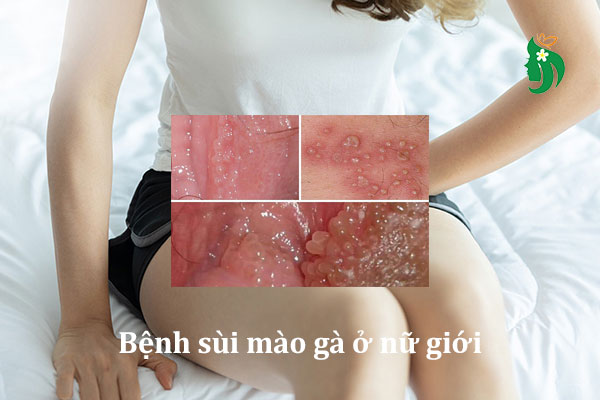 Sùi mào gà ở nữ giới: Dấu hiệu, nguyên nhân và cách điều trị hiệu quả