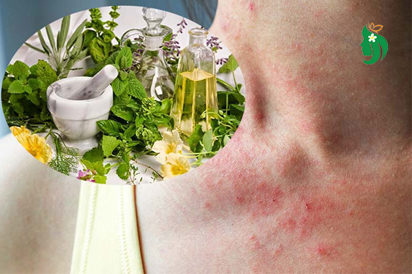 Viêm da dị ứng tắm lá gì để giảm ngứa và phục hồi da nhanh?