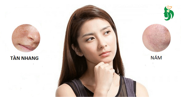 Phân biệt nám và tàn nhang