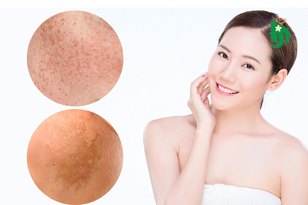 Cách chăm sóc da mặt bị nám và tàn nhang hiệu quả tại nhà