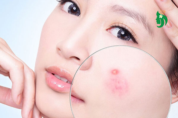 Cách chăm sóc da mặt dầu mụn tại nhà hiệu quả, an toàn cho da nhạy cảm