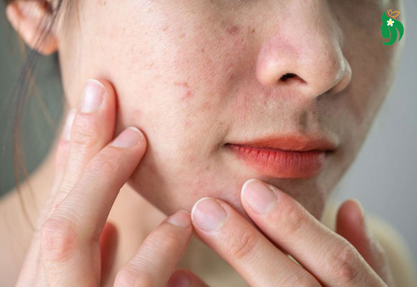 Cách chăm sóc da mặt mỏng yếu chi tiết theo từng bước