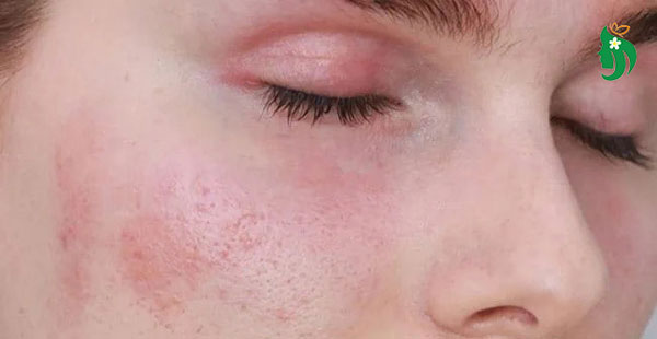 Những sai lầm cần tránh khi chăm sóc da mặt mỏng yếu