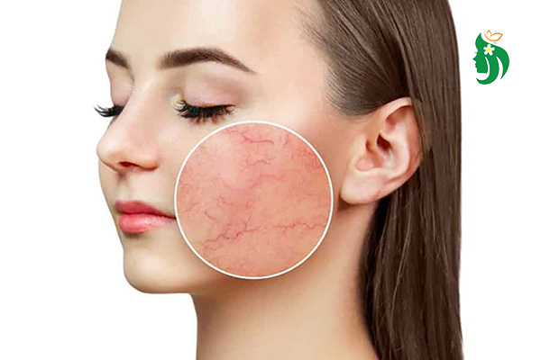 Cách chăm sóc da mặt mỏng yếu: Hồi phục làn da khỏe mạnh từ bên trong