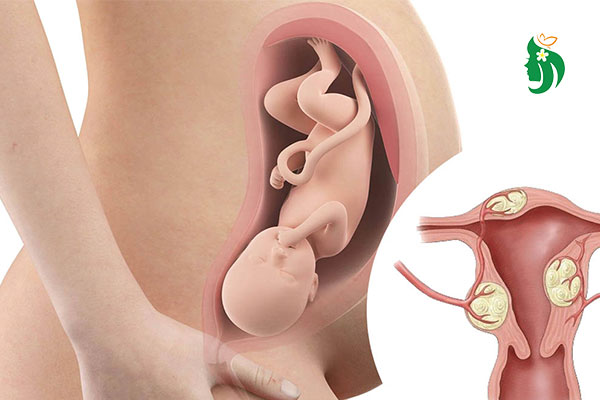 Cắt u xơ tử cung có thai được không? Giải đáp từ chuyên gia sản phụ khoa