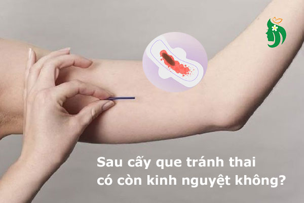 Cấy que tránh thai có kinh nguyệt không?