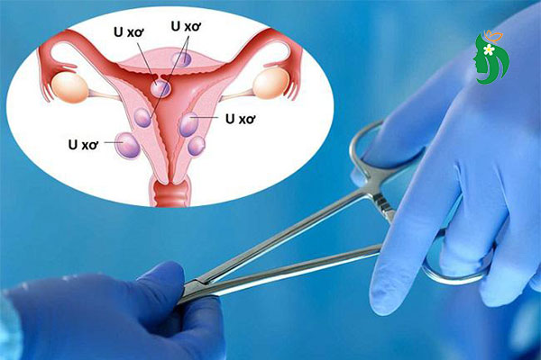 Chuẩn bị gì khi đi mổ u xơ tử cung? Hướng dẫn chi tiết