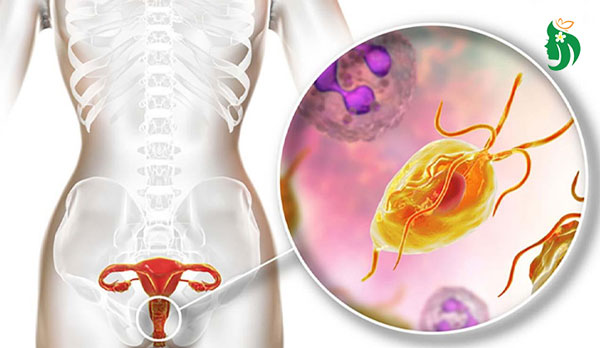 Viêm âm đạo do Trichomonas