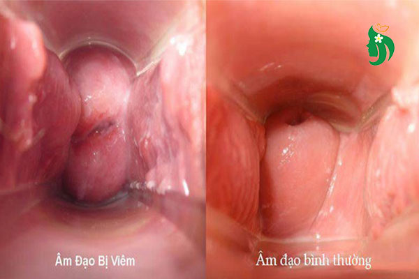 Hình ảnh viêm âm đạo: Dấu hiệu nhận biết và cách xử lý hiệu quả