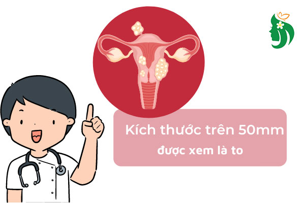 Kích thước u xơ tử cung bao nhiêu là to?