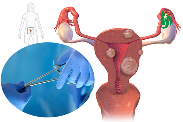 Kích thước u xơ tử cung bao nhiêu là to? Phụ nữ nên cảnh giác