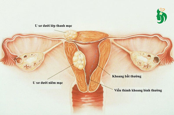Nhân xơ tử cung là gì?