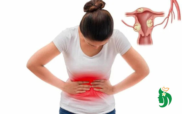 Triệu chứng của nhân xơ tử cung