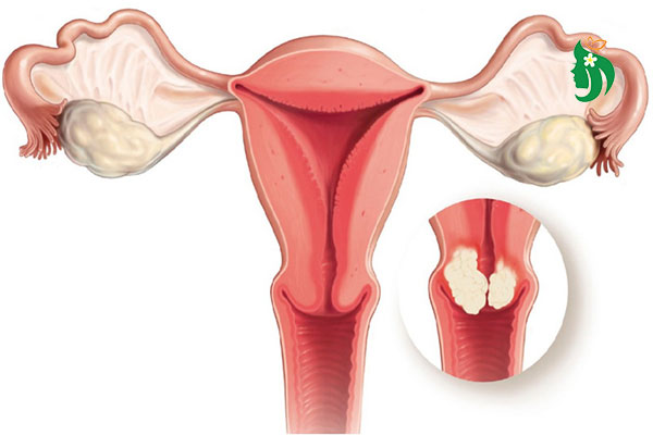 Nhân xơ tử cung là gì? Nguyên nhân, dấu hiệu và cách điều trị