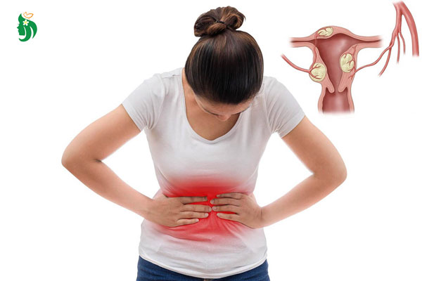 Tình trạng u xơ tử cung đau bụng dưới, chị em nhớ cảnh giác!