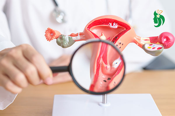 Phát hiện u xơ tử cung bằng cách nào? Chuyên gia hướng dẫn từ A–Z