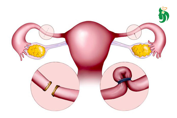Triệt sản là gì? Những điều cần biết