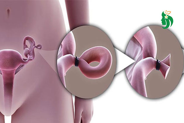 Triệt sản có kinh nguyệt không? Giải đáp từ chuyên gia sức khỏe sinh sản