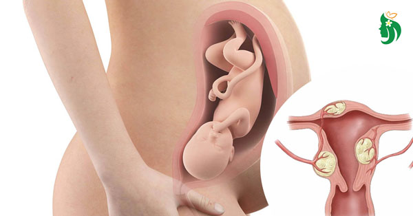 U xơ tử cung có di truyền không?