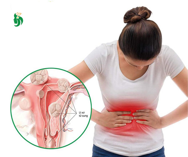 U xơ tử cung là gì?