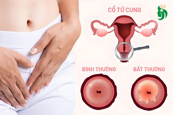 viêm cổ tử cung có thai được không