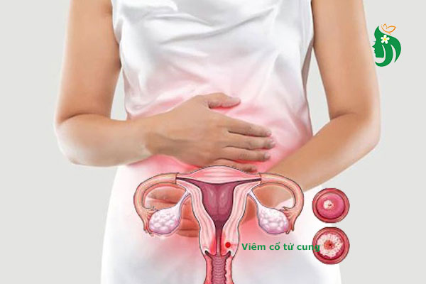 Viêm cổ tử cung có thai được không? Giải đáp từ chuyên gia