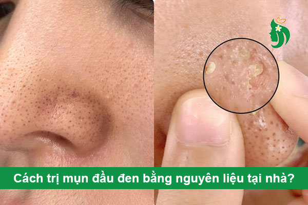 Cách trị mụn đầu đen bằng nguyên liệu tại nhà? Checklist hiệu quả + lưu ý rủi ro