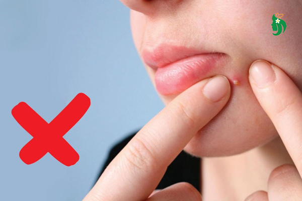 5 rủi ro khi tự nặn mụn tại nhà