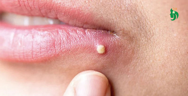 Khi nào có thể xử lý mụn tại nhà?