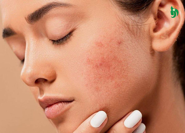 Bị mụn có nên trang điểm không và cần lưu ý gì?